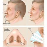 quanto custa rinoplastia para nariz achatado Vila Andrade