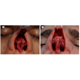 rinoplastia para agrandar nariz preço Morumbi