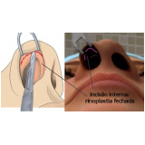 rinoplastia para agrandar nariz Morumbi