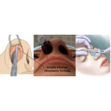 rinoplastia para empinar o nariz São Paulo