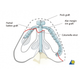 rinoplastia para nariz achatado preço Taboão da Serra