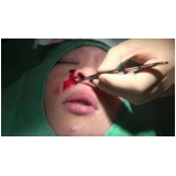 rinoplastia para nariz achatado Santo Amaro