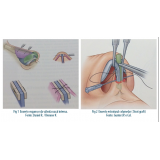 rinoplastia para nariz negroide preço Vila Andrade