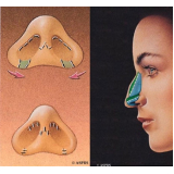 rinoplastia para nariz negroide Morumbi