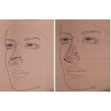 Rinoplastia para Empinar o Nariz