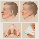 Rinoplastia para Homens