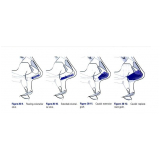 Rinoplastia para Nariz Achatado
