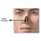 Rinoplastia para Nariz de Batata