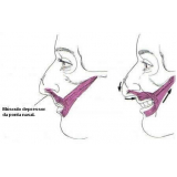 Rinoplastia para Rosto Redondo