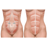 Abdominoplastia
