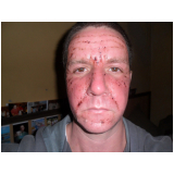 tratamento de pele com laser valor São Paulo