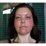 tratamento de pele com laser Morumbi