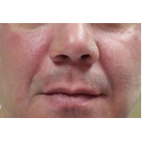 tratamento de pele laser co2 fracionado valor São Paulo