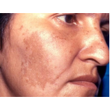 tratamento de pele manchas preço São Paulo