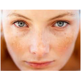 tratamento de pele manchas valor São Paulo