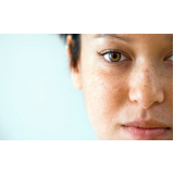 tratamento de pele manchas São Paulo