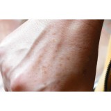 tratamento de pele para manchas preço São Paulo