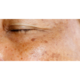 tratamento de pele para manchas Santo Amaro