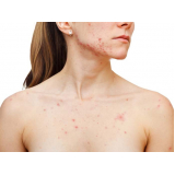 tratamento de pele para tirar manchas valor Morumbi