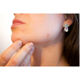 tratamento de pele para tirar manchas Taboão da Serra