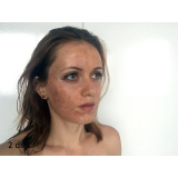 Tratamento de Pele com Laser