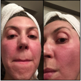 Tratamento de Pele Laser Co2 Fracionado